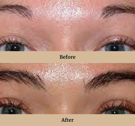 <p>After your initial consultation at Evolved Clinic Perth and Brisbane, your Hair Transplant Doctor will design a transplant plan to create symmetrical eyebrows that look full and natural.</p>
<p>On the day of your treatment, you will relax in a comfortable position and your Hair Transplant Doctor will gently harvest your donor hair follicles. Next, they will carefully implant each individual follicle at just the right depth and angle to ensure the results will blend with the rest of your brows.</p>
<p>When your transplant is complete, you’ll receive instructions for care and grooming of your new eyebrows. You might have some mild swelling or redness after your procedure, but this typically goes away within 24 hours.</p>
<p>Your implanted eyebrow hairs will continue to grow normally for the rest of your life, just like your original eyebrows.</p>
