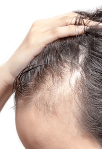Which Hair Loss Treatment is right for me?
