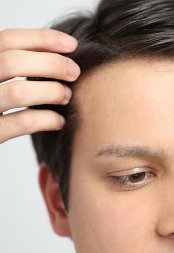 Do’s and Don’ts before and after a Hair Transplant