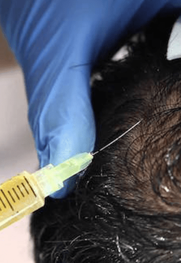 How PRP works to regrow hair