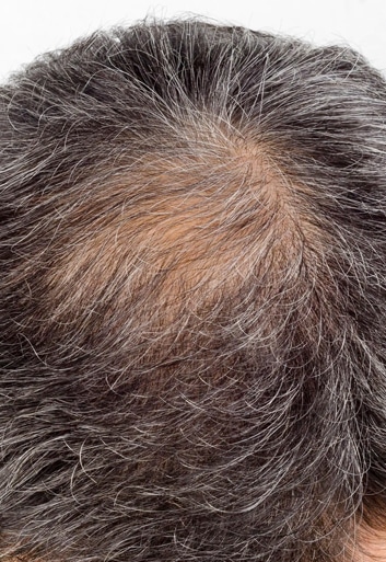 Do All Men Notice Balding Before They Turn 40?