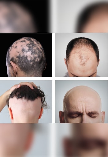 Types of Alopecia. Which one do I have?