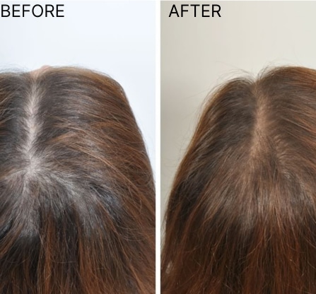 <p>Do a Free Consult with a Qualified Trichologist at Evolved Clinics Perth and Brisbane</p>
<p>Start with a diagnosis from a Trichologist, who will examine the root cause of your hair loss.</p>
<p>There is <strong>NO one answer or treatment</strong> to a hair loss or scalp condition. Each situation must be identified, assessed & investigated on its merits. Only then can we truly address the cause and give back what we all desire.</p>
<p>We are proud to have one of the most experienced International Trichologists in Australia, Paul M Green, and we’ll be happy to book an appointment should you wish to run a 30-45 min free diagnostic consultation with him.</p>