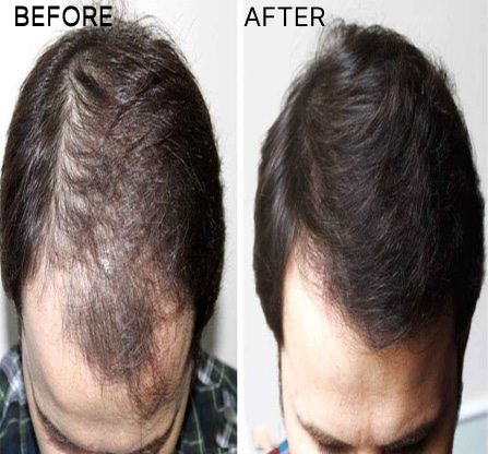 <p>Your Bespoke Treatment Plan</p>
<p>Evolved Clinics at Perth and Brisbane adopt an expanded protocol providing “Standard” hair loss treatments for early hair loss candidates to a “3-in-1” Platinum Combo for more advanced hair loss. The benefits of combining various modes of treatment, backed by clinical research, enhances your chances of sustained hair growth over a longer period</p>