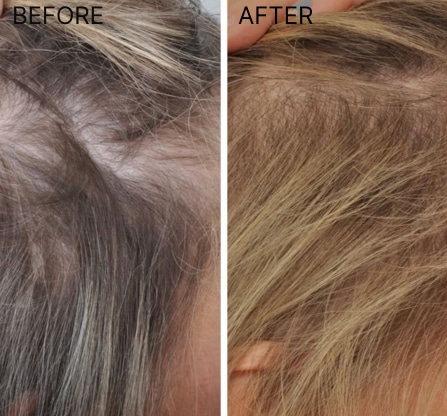 <ol class="listing-row">
<li>PRP Hair Treatment is a 100% natural procedure promoting hair regrowth using your own growth factors to areas of scalp with hair loss.</li>
<li>Meso Hair Treatment is a research-based, combination of nutrients delivered directly to your scalp and one-of-its-kind treatment available in Western Australia.</li>
<li>Laser Hair Therapy, is an FDA cleared, stimulating protocol using laser device to emit wavelengths of light onto your scalp.</li>
</ol>