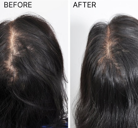 <p>Our hair regrowth treatments have the following advantages –</p>
<ol class="listing-row">
<li>Promotes less thinning and accelerates hair regrowth.</li>
<li>Increases diameter and density of hairs so gets you a fuller head of hair.</li>
<li>Conserves existing hair by slowing down or reversing the miniaturizing process in your hair</li>
</ol>
<h4><strong><em>Non-Invasive. 100% Safe. No Pain. No side effects.</em></strong></h4>