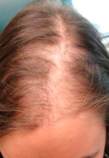 PRP for Female hair loss