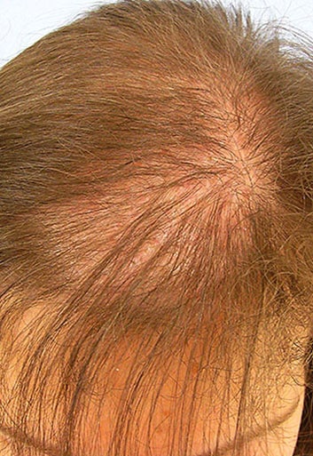 Thyroid Causing Hair Loss