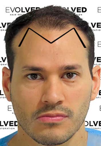 Is your hairline looking like a ‘U’ or ‘M’ shape?