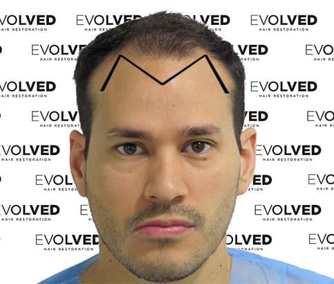 Is your hairline looking like a 'U' or 'M' shape?
