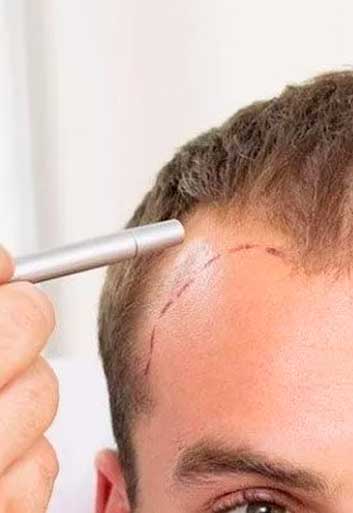 How Many Hair Transplant Surgeries Can I have?