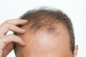 Does Losing Hair Every Day Mean I'm Going Bald?
