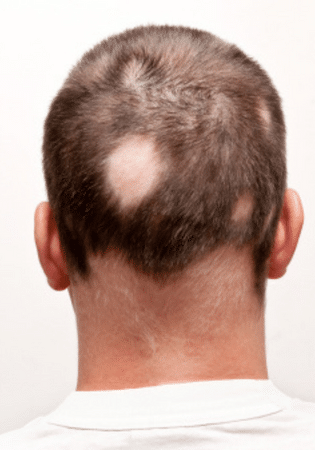 Alopecia Areata: Balding in patches