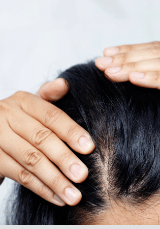 Hair Shedding After Hair Transplant | Evolved hair restoration