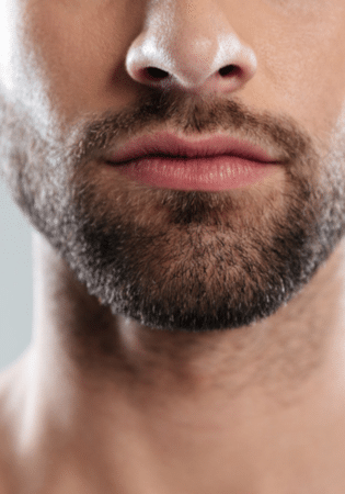 Beard Transplant Risks : Pros and Cons