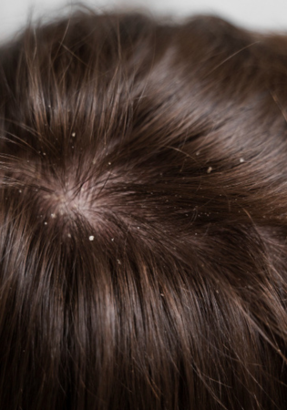 Dandruff and Its Impact on Transplanted Hair Growth