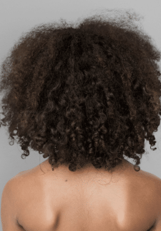 All About Afro-American Female Hair Transplant