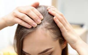 Hair Loss