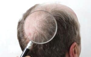 hair transplant perth