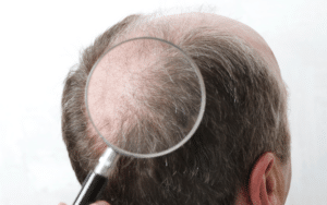 Hair transplant results