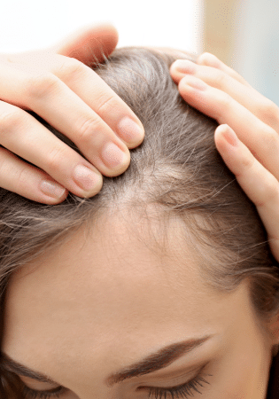 Hair Transplant and Hormonal Imbalances: Insights