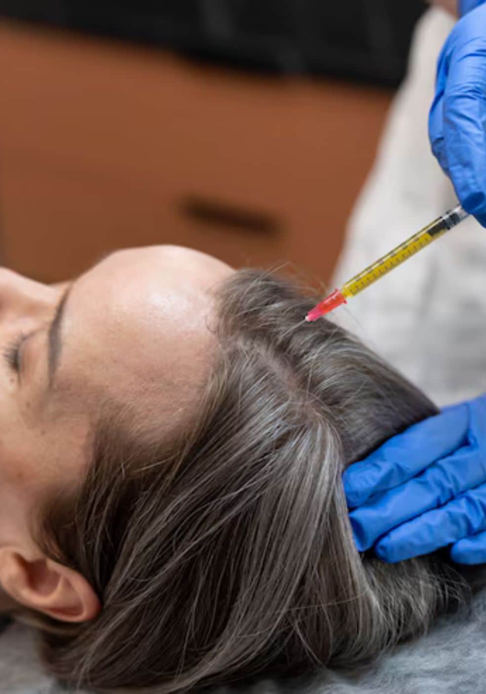 PRP Hair Treatment in Perth: The Revolutionary Solution for Hair Loss