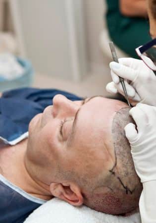 Best Hair Transplant in Australia: Why More People Are Choosing Perth Clinics