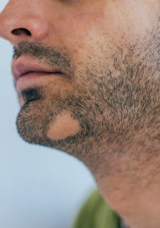 How Much Does a Beard Transplant Cost in Perth? Full Price Breakdown