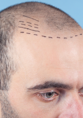 Best Hair Transplant & Hair Implants: Natural, Scar-Free Results?