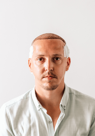 Perth Hair Transplant: What to Expect and How to Find Near Me