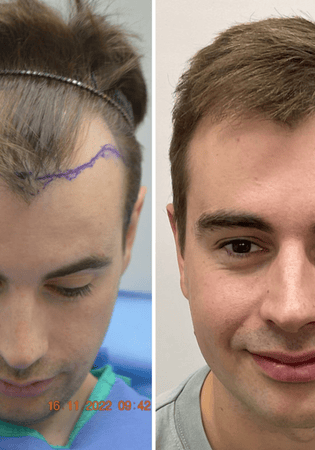 Ultimate Hair Treatment Perth & Hair Transplant Cost Perth Guide