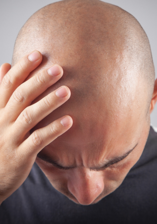 Honest Hair Transplant Costs in Perth | No Hidden Fees