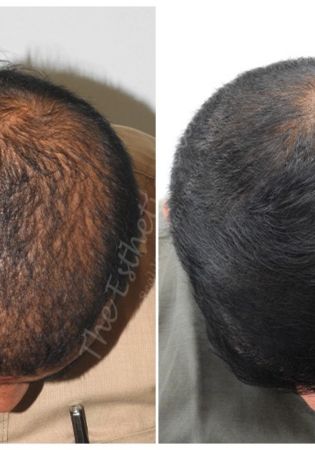 Beyond PRP: Supercharging Hair Growth with Exosome Hair Treatment