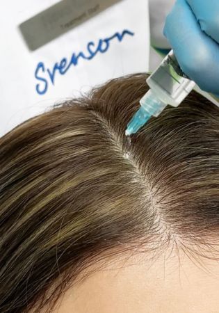 Discover Exosome Hair Treatment with Evolved Hair Restoration Clinic — Where Regeneration Meets Results