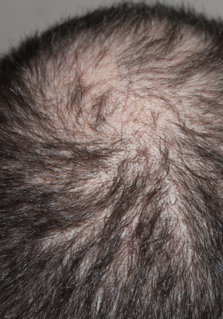 Why Choosing Hair Transplant at Evolved Hair Restoration Clinic in Australia Is Safer Than Turkey or Bali