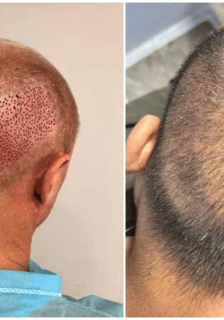 Donor Regeneration Insights from Evolved Hair Restoration Clinic