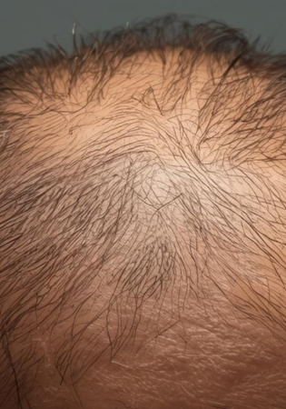 Your Complete Guide to Hair Implants: From Consultation to Recovery