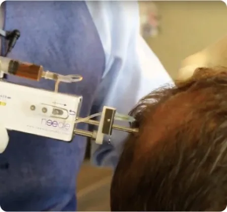 Hair Transplant & Hair Loss Treatment Clinic in Perth